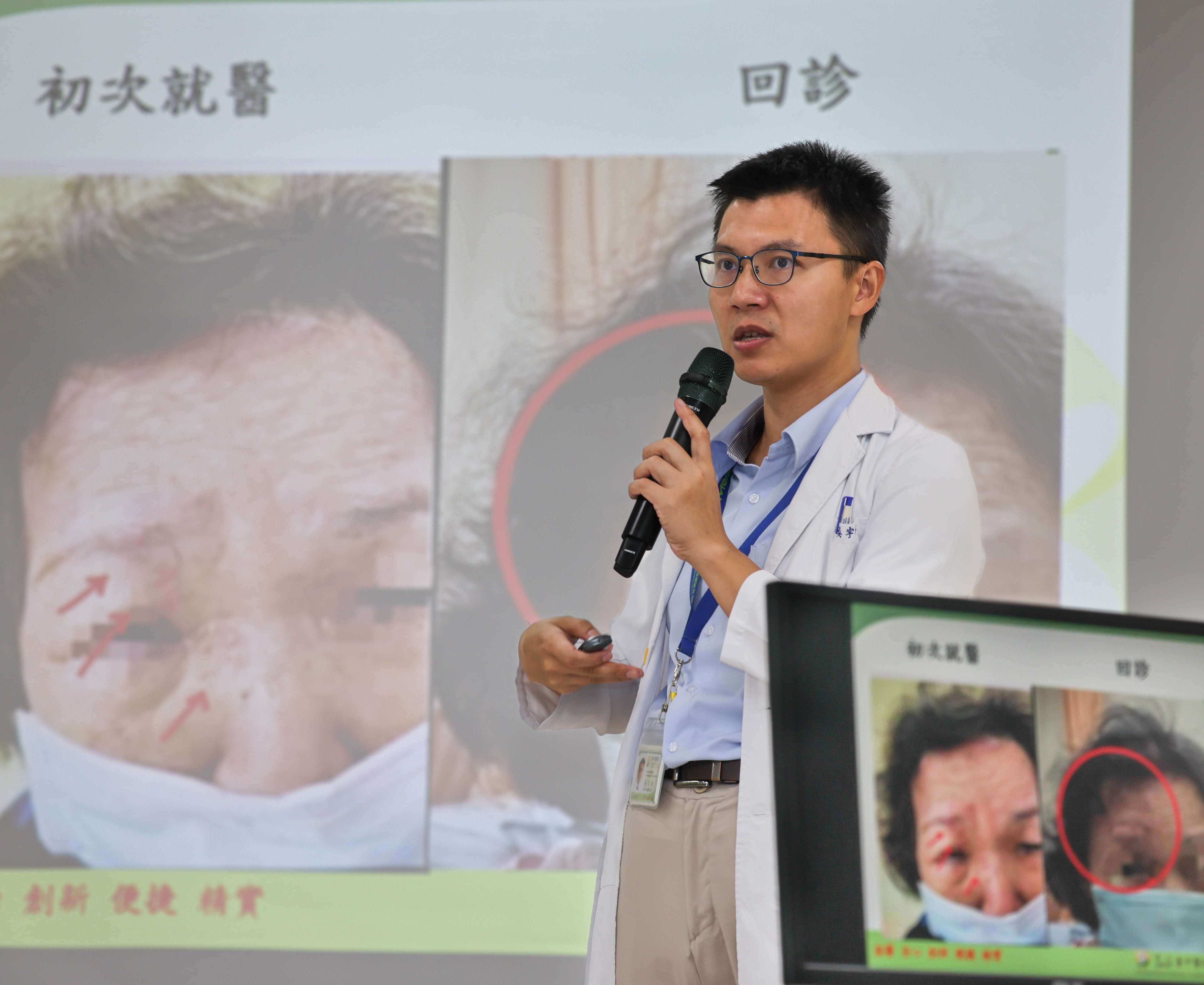婦人眼角冒水皰確診帶狀皰疹 臺中醫院跨科即時診治化解失明與腦炎危機