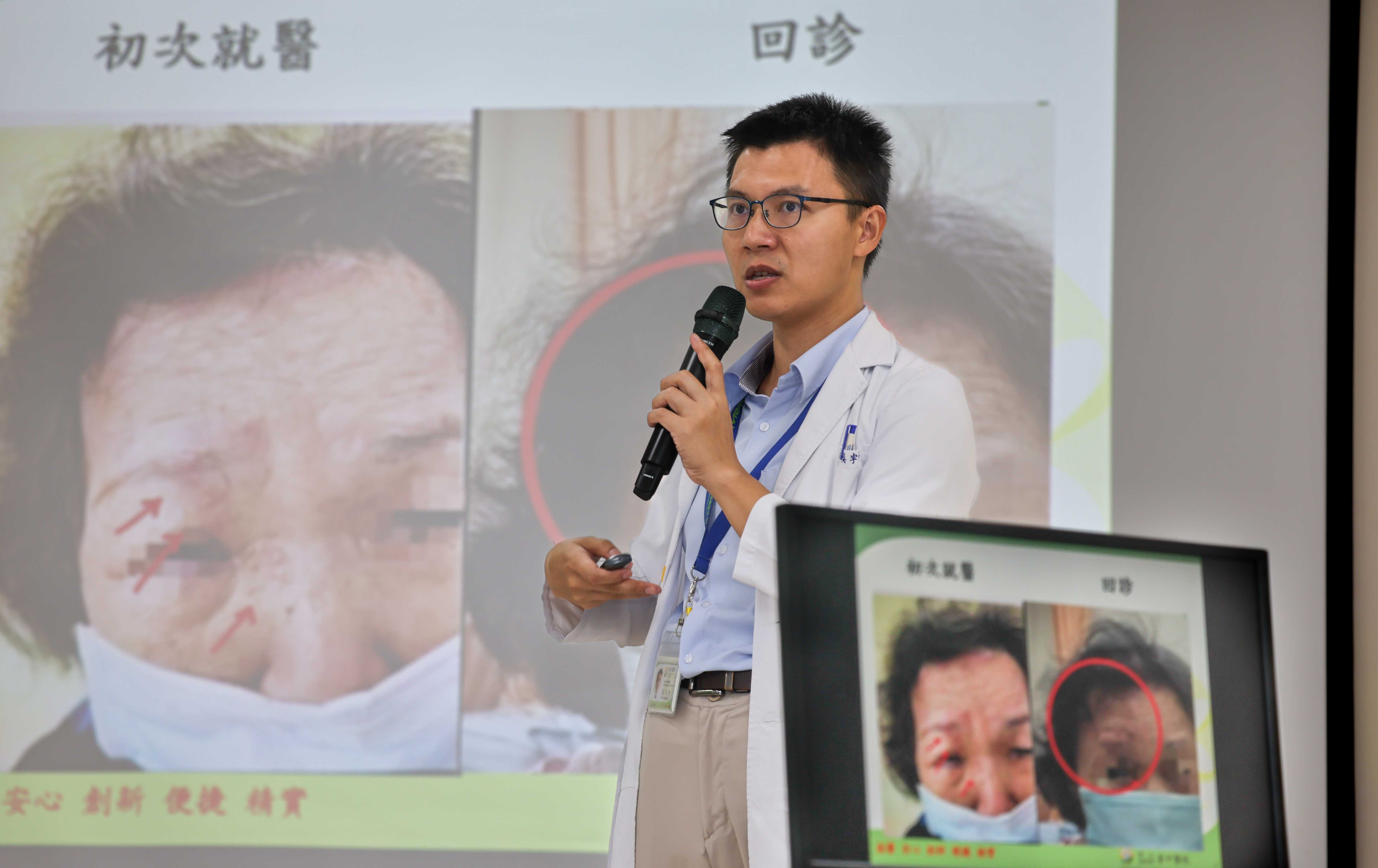 婦人眼角冒水皰確診帶狀皰疹 臺中醫院跨科即時診治化解失明與腦炎危機